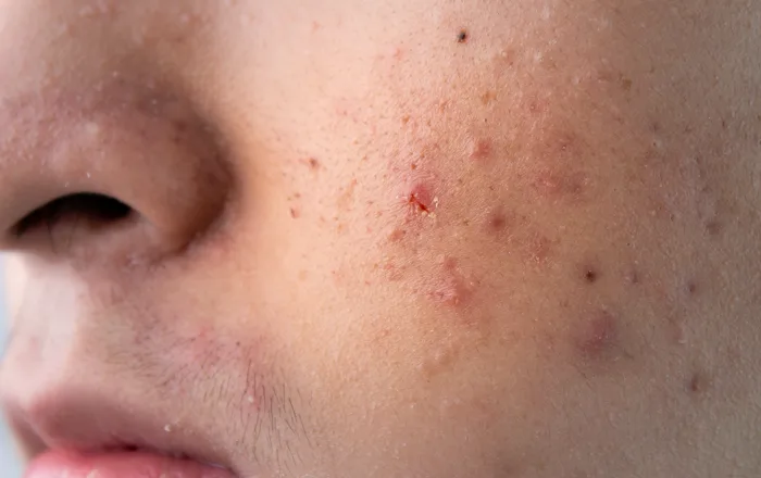 Acne — Tratamento Clínico, Dra. Joicy Stering, Campo Grande MS