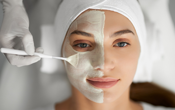 Peeling Químico